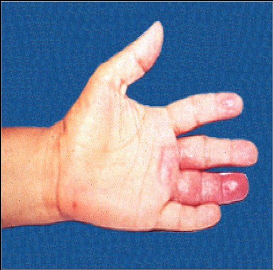 fotos de lepra_thumb[1].jpg